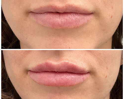 before and after dermal fillers in doylestown