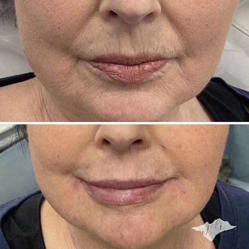 before and after dermal fillers in doylestown