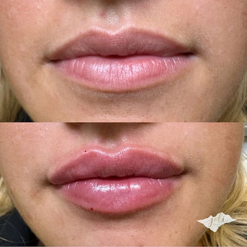 lip-filler-1-1