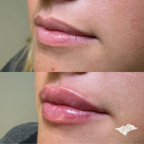 lip-filler-1-2
